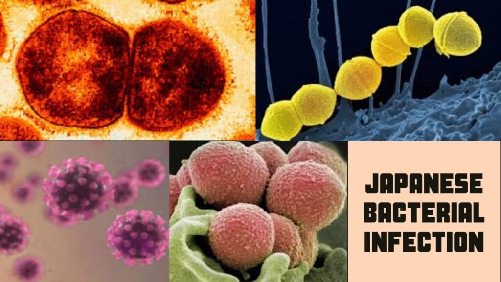 Japanese bacterial infection – Flesh-eating bacteria outbreak in Japan is causing tissue damage